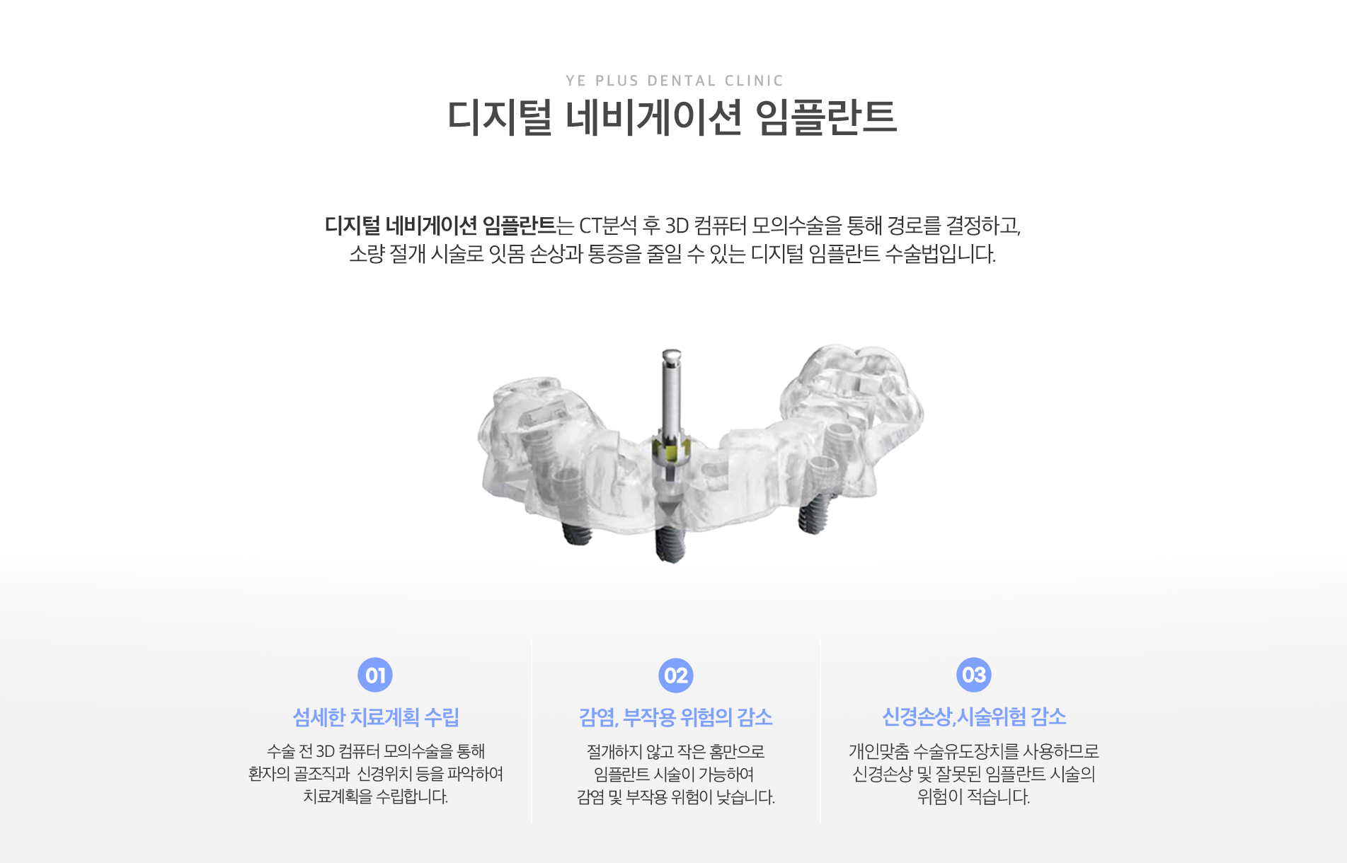 디지털임플란트