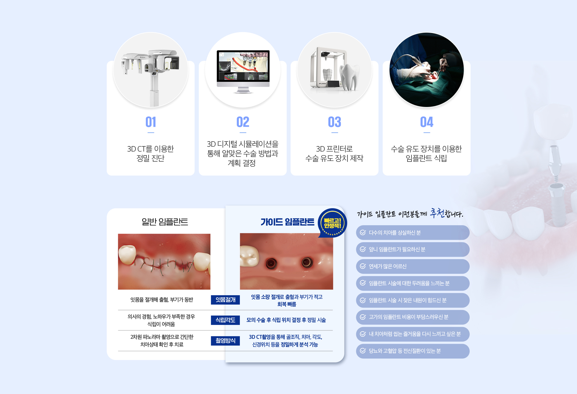 디지털임플란트 과정