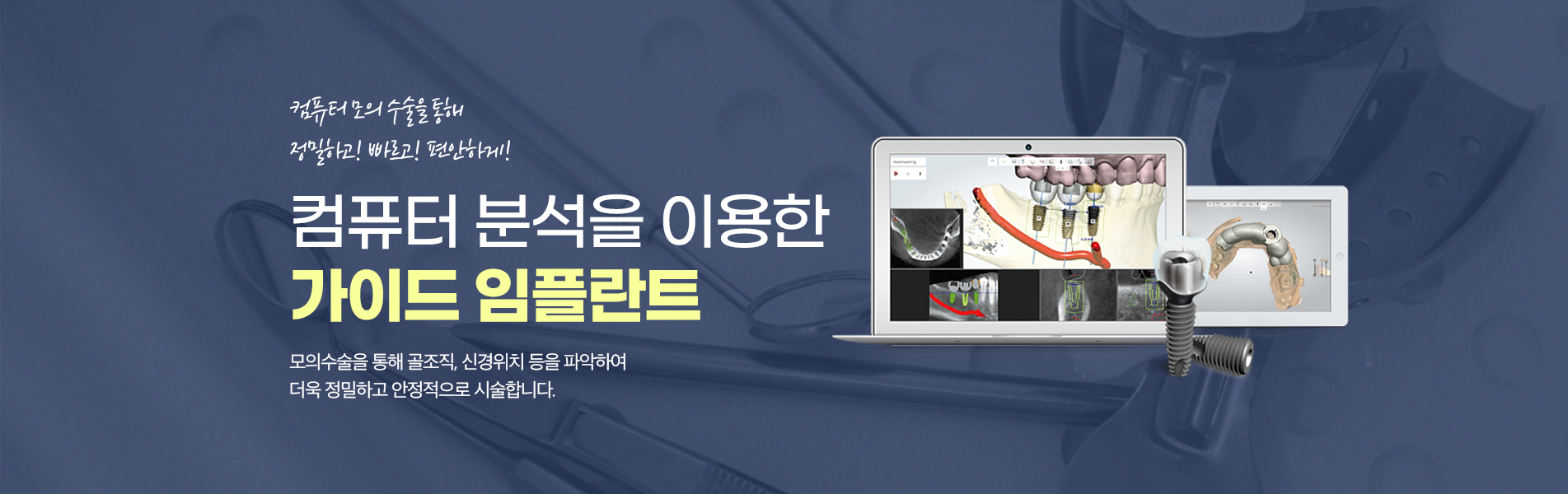가이드 임플란트