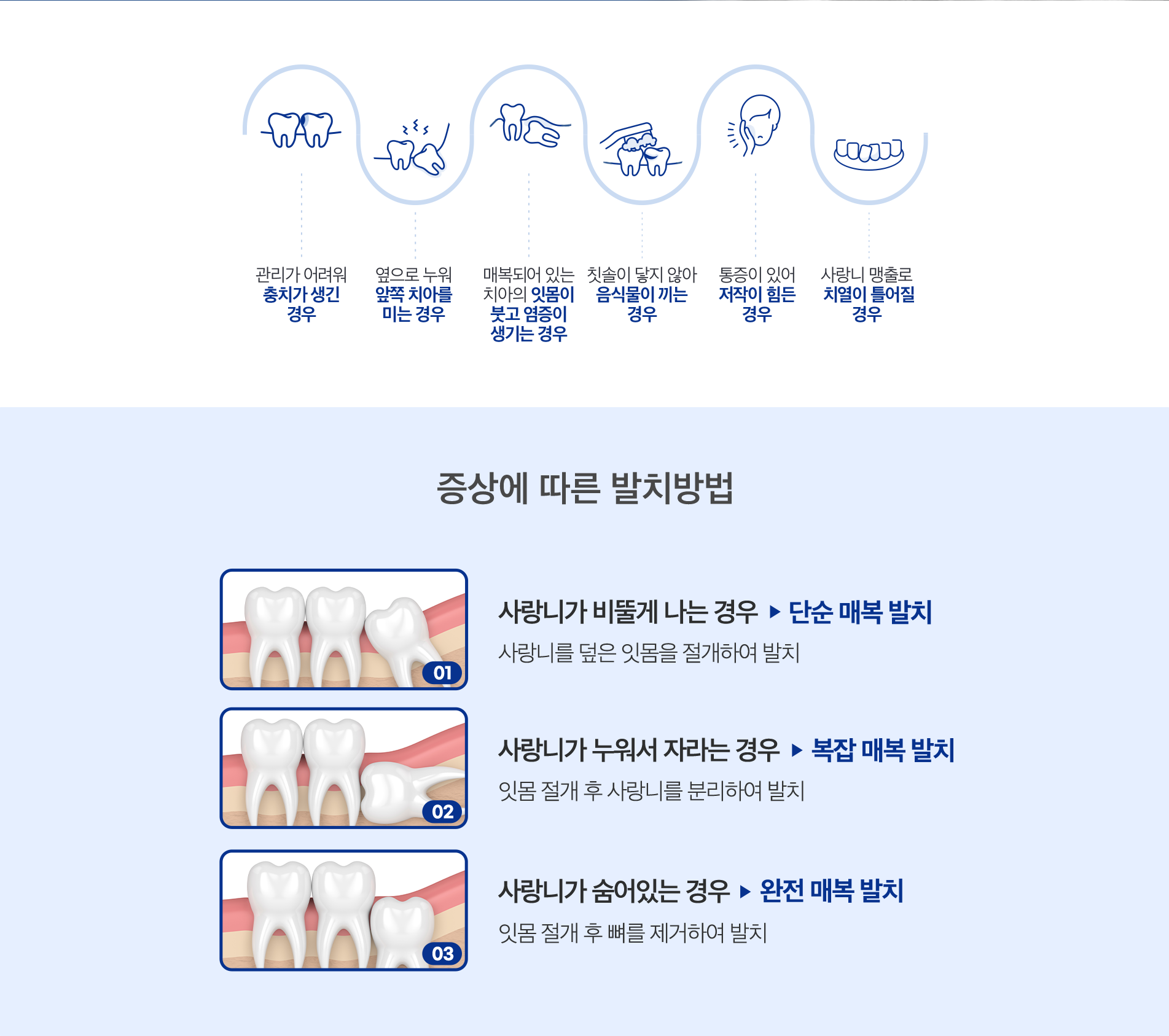 사랑니발치