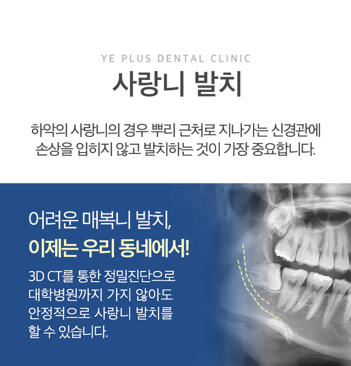 사랑니 발치