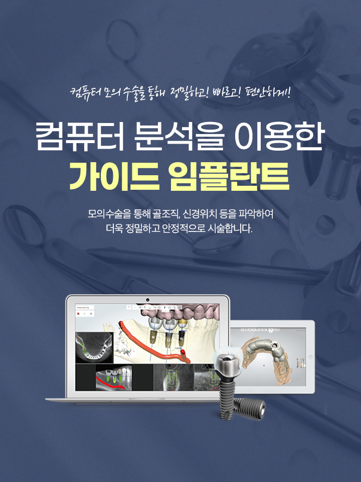 가이드 임플란트