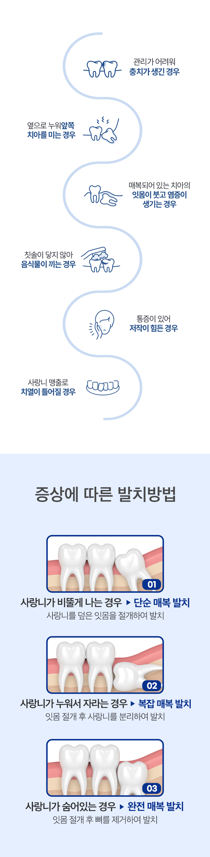 사랑니 발치